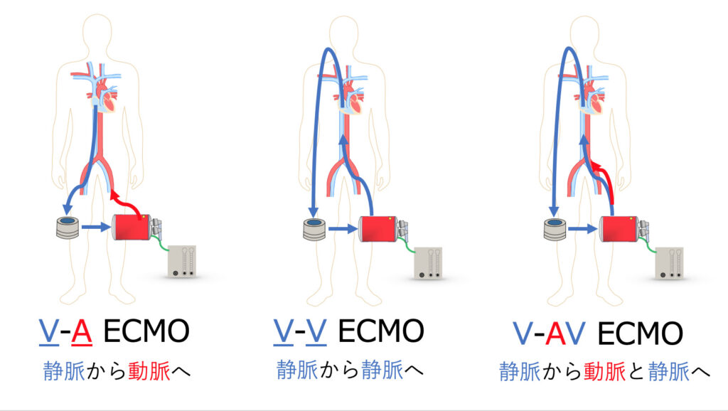 ECMO分類