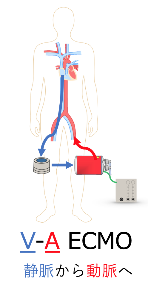 V-A ECMO絵