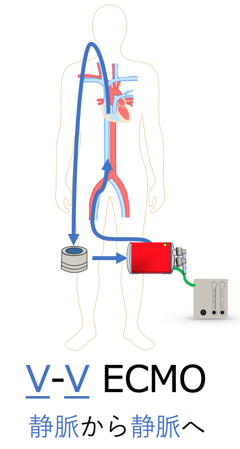 V-V ECMO絵